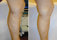 Before and After Treatmente